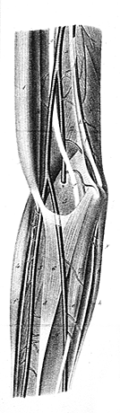 Image of expansive lacertus fibrosus entrapping the ulnar artery