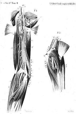 Image of high origin of pronator teres from ligament of struthers and supracondylar process of humerus