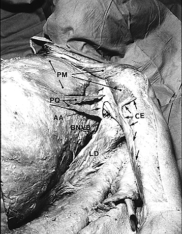 Image of a case of doubled pectoralis quartus, axillary arch and chondroepitrochlearis
