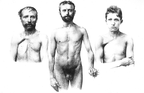 Image of three men, two with absentmanubrial, sternal and costal portions of pectoralis major