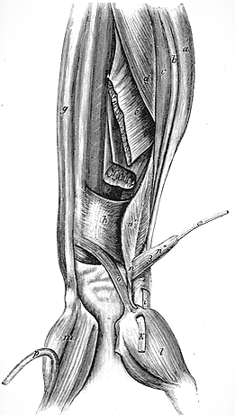 Image of radialis internus brevis biceps, cubitocarpeus, and supernumerary head of abductor digiti minimi