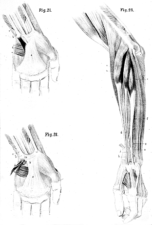 Image of duplication of extensor capri radialis brevis and division of its tendon and pisipalmaris
