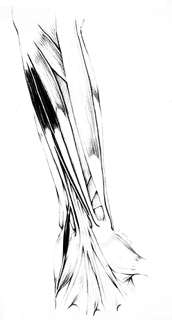 Image of doubled palmaris longus