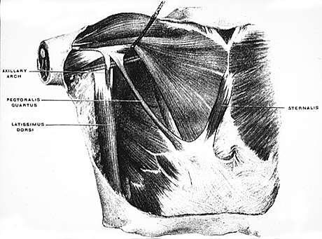 Image of axillary arch, pectoralis quartus, and sternalis