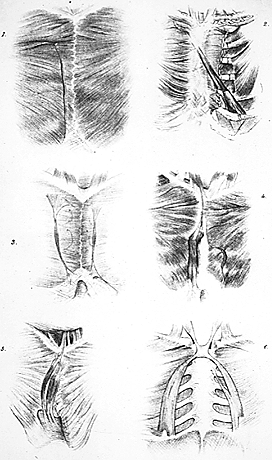 Image of varieties of sternalis muscle