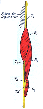 Image of an unusual flexor digitorum sublimis muscle