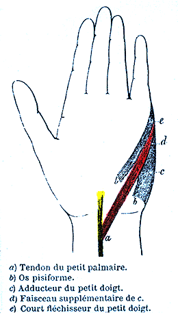 Image of accessory flexor digiti minimi brevis from tendon of palmaris longus