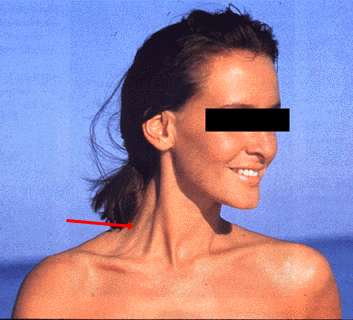 Image of a levator claviculae on a woman