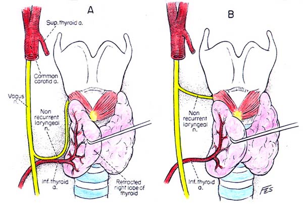 The course of the non laryngeal nerve: (A) accompanying the inferior thyroid 
