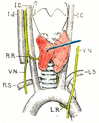 Diagram of the common associated anomalies of the right recurrent laryngeal 