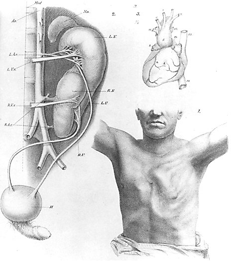 Congenital S-shaped kidney