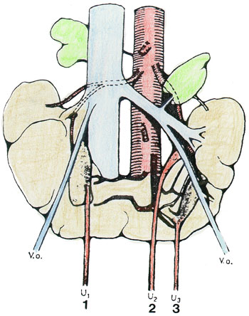  arteries are red, the adrenal glands are green, and the horseshoe kidney 