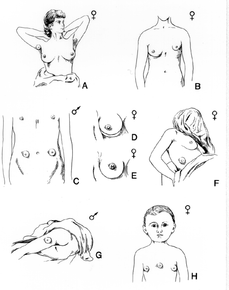 Variations in Size, Number, Location, and Structure of the Mammary Gland in Men and Women