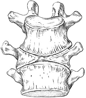 A Divided Thoracic Vertebra (after Turner)