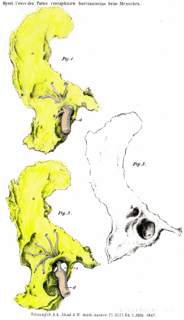 Porus crotaphitico-buccinatorius of the right wing of the sphenoid bone