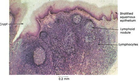 Plate 9.162 Palatine Tonsil
