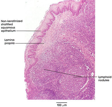 Plate 9.163 Lingual Tonsil