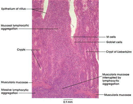 Plate 10.203 Ileum: Lymphocytic aggregation