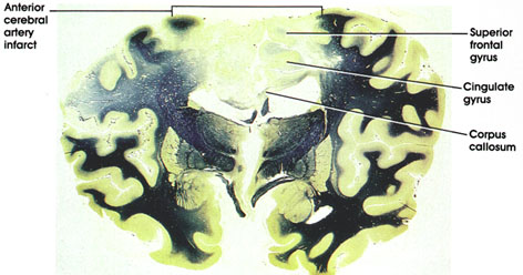 Plate 17.349 Anterior Cerebral Artery Infarct