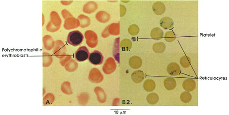 Plate 4.55: Bone Marrow; Peripheral Blood