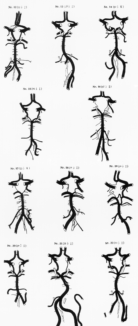 Image of variations in circle of Willis