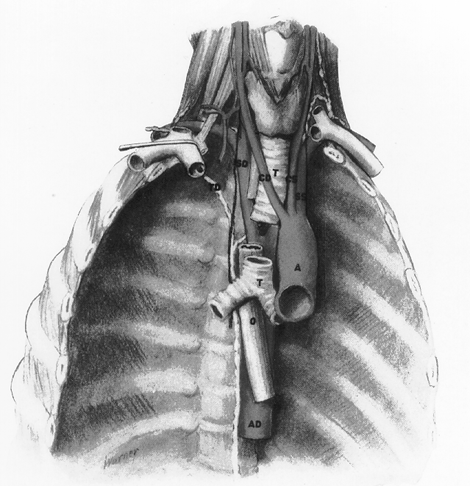 Image of aortic arch variation