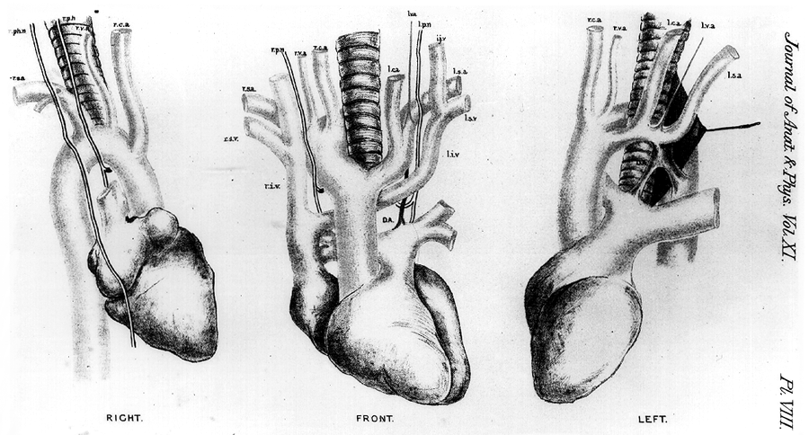 Image of double aortic arch