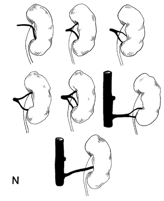 Image of renal vessel variations