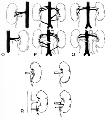 Image of renal vessel variations