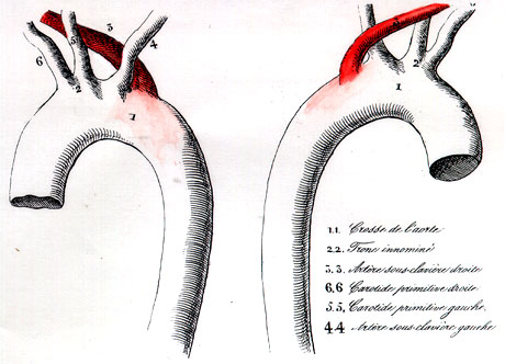 Image of retroesophageal right subclavian artery