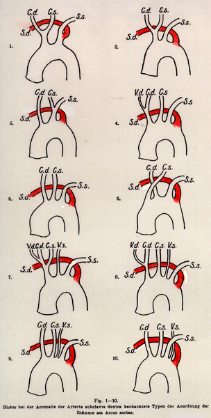 Image of types of retroesophageal right subclavian arteries