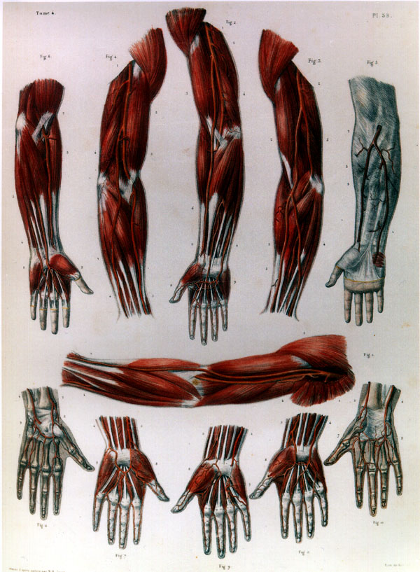 Image of high origin of radial and ulnar arteries