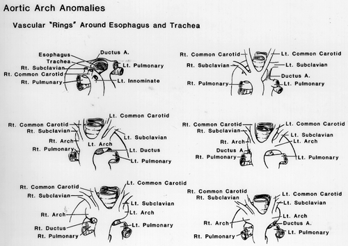 Image of vascular rings aroudn esophagus and trachea