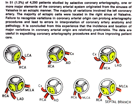 Image of variations in origin of coronary arteries