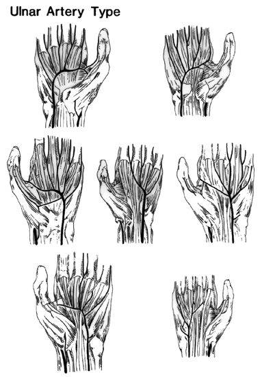 Image of ulnar artery, superficial palmar arch, ulnar dominance