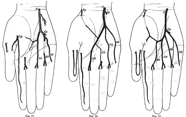 Image of some variations in deep palmar arch