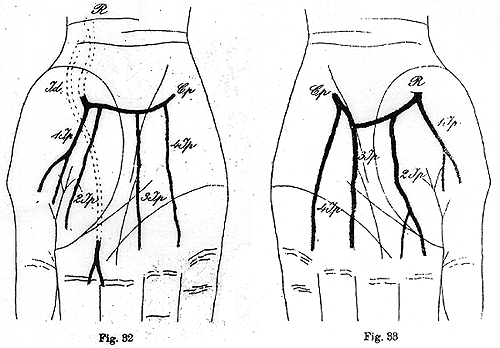 Image of some variations in deep palmar arch