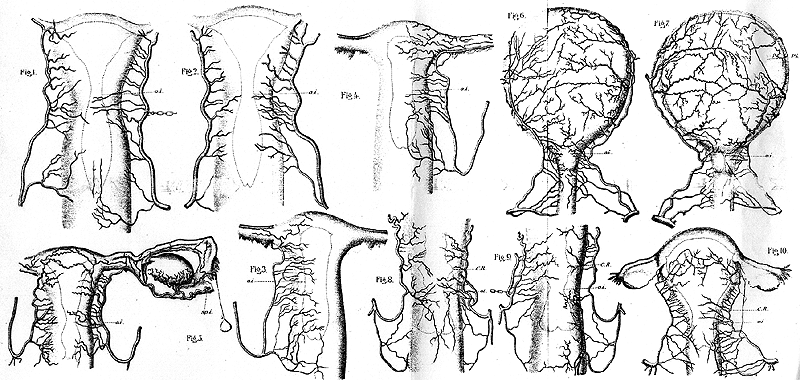 Image of variations in the uterine blood supply