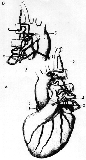 Image of coronary artery arising from pulmonary artery