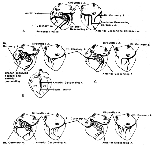 Image of variation in coronary arteries