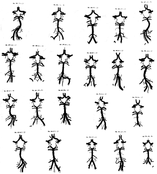 Image Of Variations In Circle Of Willis Image Of Variations In Circle Of Willis