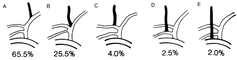 Image of origin of ascending cervical artery