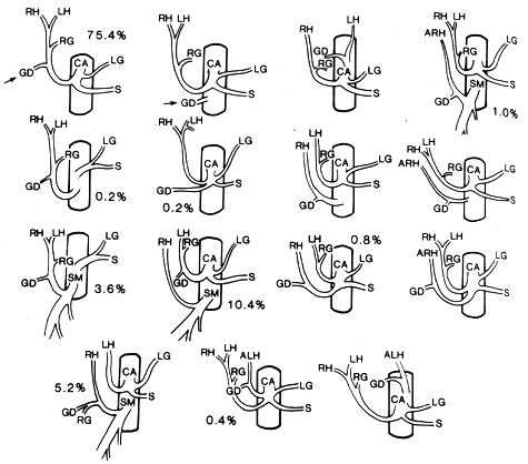 Image of variations in origin of gastroduodenal artery