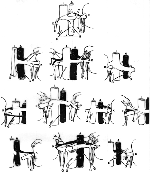 Image of gonadal artery variations and the renal pedicle