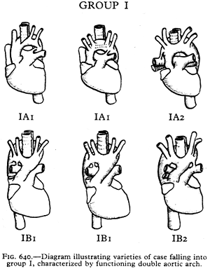 Image of double aortic arch