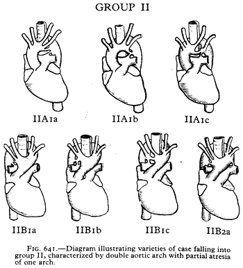 Image of double aortic arch