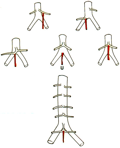 Image of middle sacral and lumbar arteries