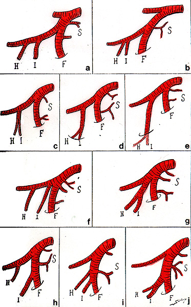 Image of frequency of variation of posterior division branches of the internal iliac artery