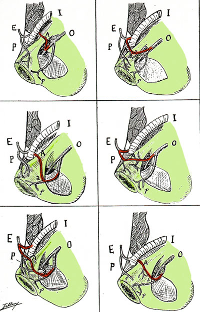 Image of variations in external and internal iliac artery anastomoses