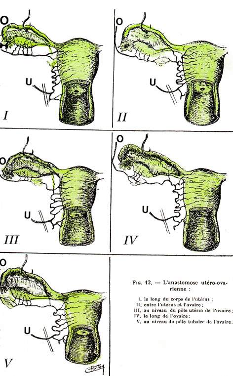 Image of anastomoses between the ovarian and uterine arteries